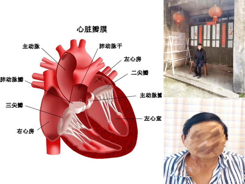 瓣膜性心脏病患者治疗项目