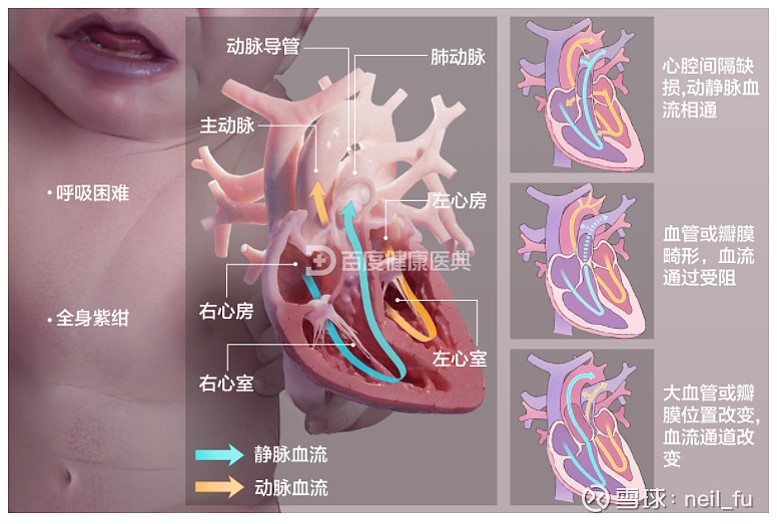 瓣膜性心脏病专项基金